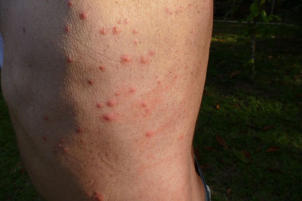 Bed bug bites on skin